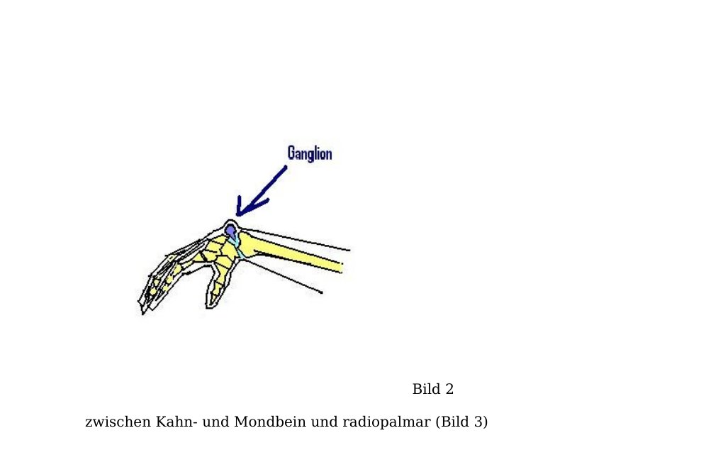 EinleitungDEFINITION: Das Wort Ganglion stammt aus dem Griechischen und bedeutet "Gewebsknoten". Das Ganglion ist eine gutartige Geschwulstbildung unterschiedlichster Größe an den Gelenken mit einer Verbindung zum Gelenkskapsel. Es ist sozusagen eine Ausstülpung der Gelenkskapsel, die eine meist gestielte Vebindung  zum Gelenksbinnenraum hat. …